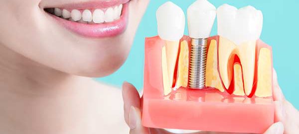 dental implant in rohini